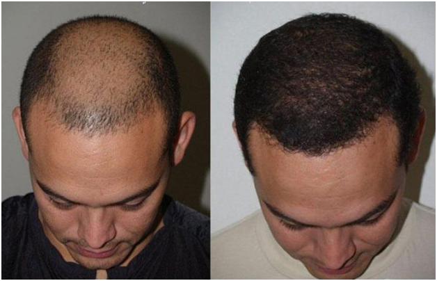 A Comprehensive Guide About How Much Is A Hair Transplant?