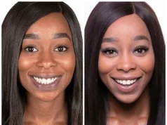 Black Gums: What Causes Them And How To Treat Them Black Gums