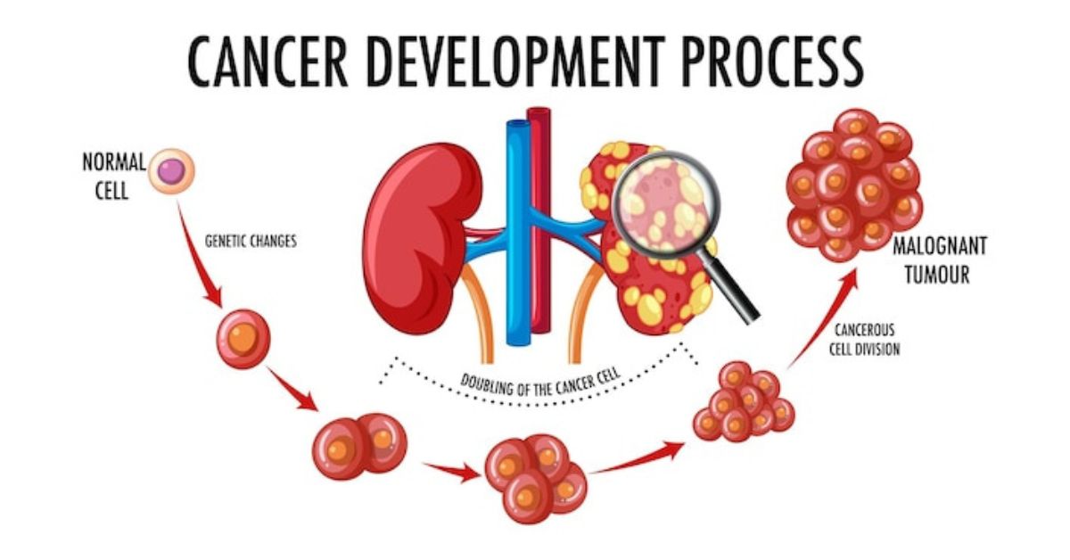How many stages of kidney cancer are there?