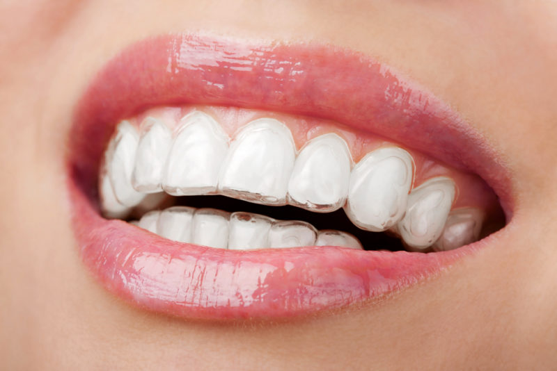 Invisalign – The Painless And Invisible Way To Straighten Teeth!