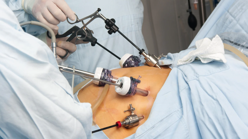 Why is Gastric Sleeve the Number One Procedure in Baltimore Gastric Sleeve